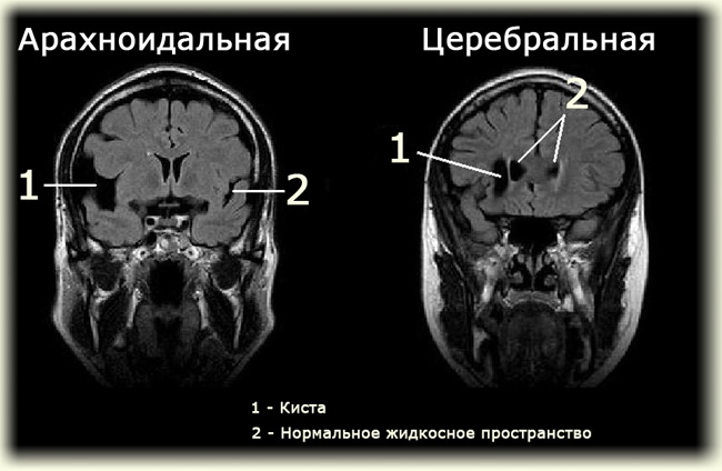 субэпендимальная киста у новорожденного ребенка